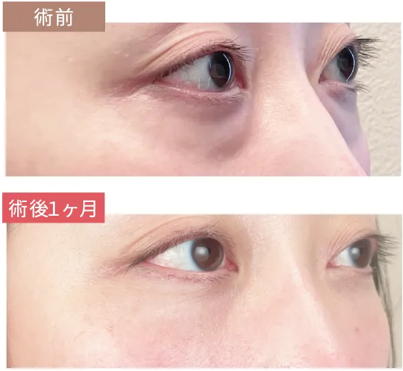 術前と術後１ヶ月の比較写真
