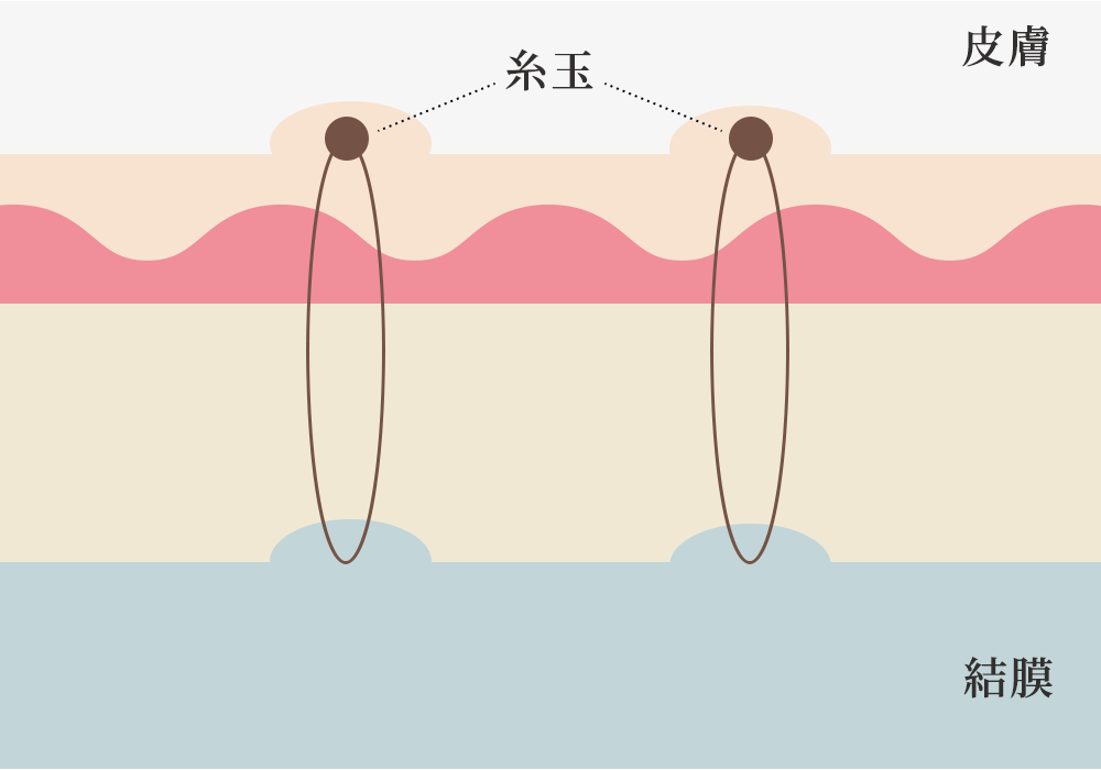 通常の埋没法