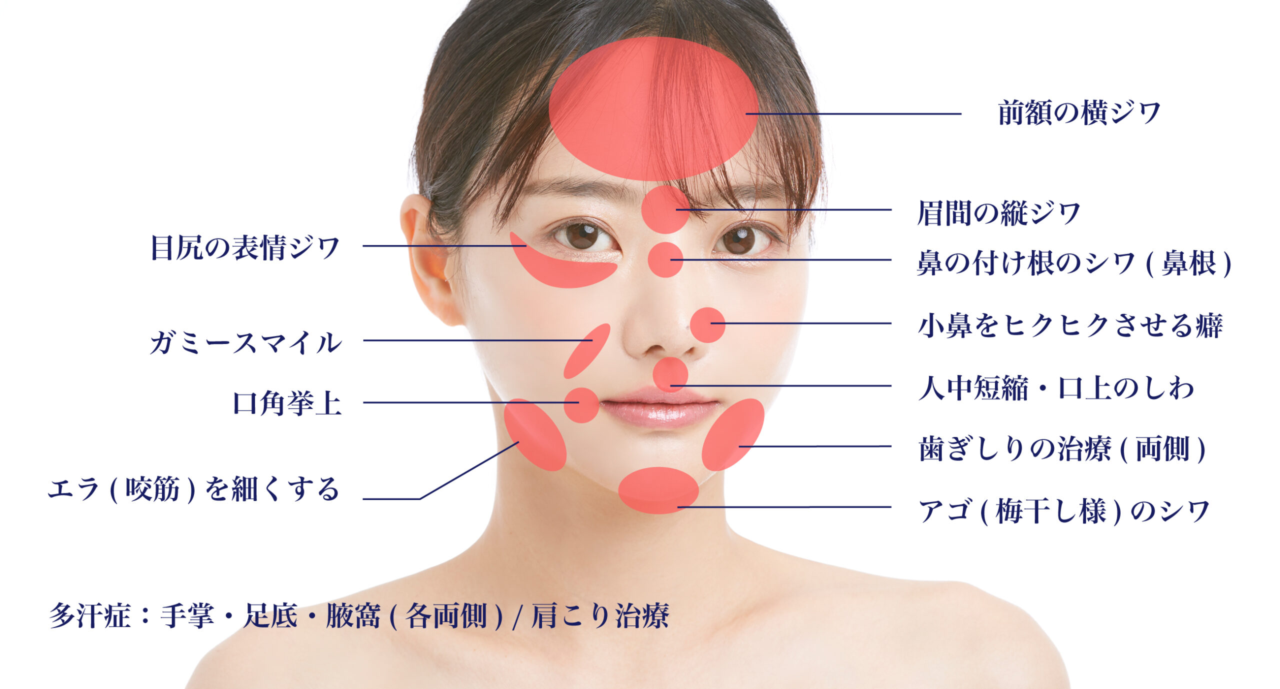 ボトックス施術箇所,眉間のしわ,額のしわ,エラ(咬筋),人中短縮,口角挙上など。