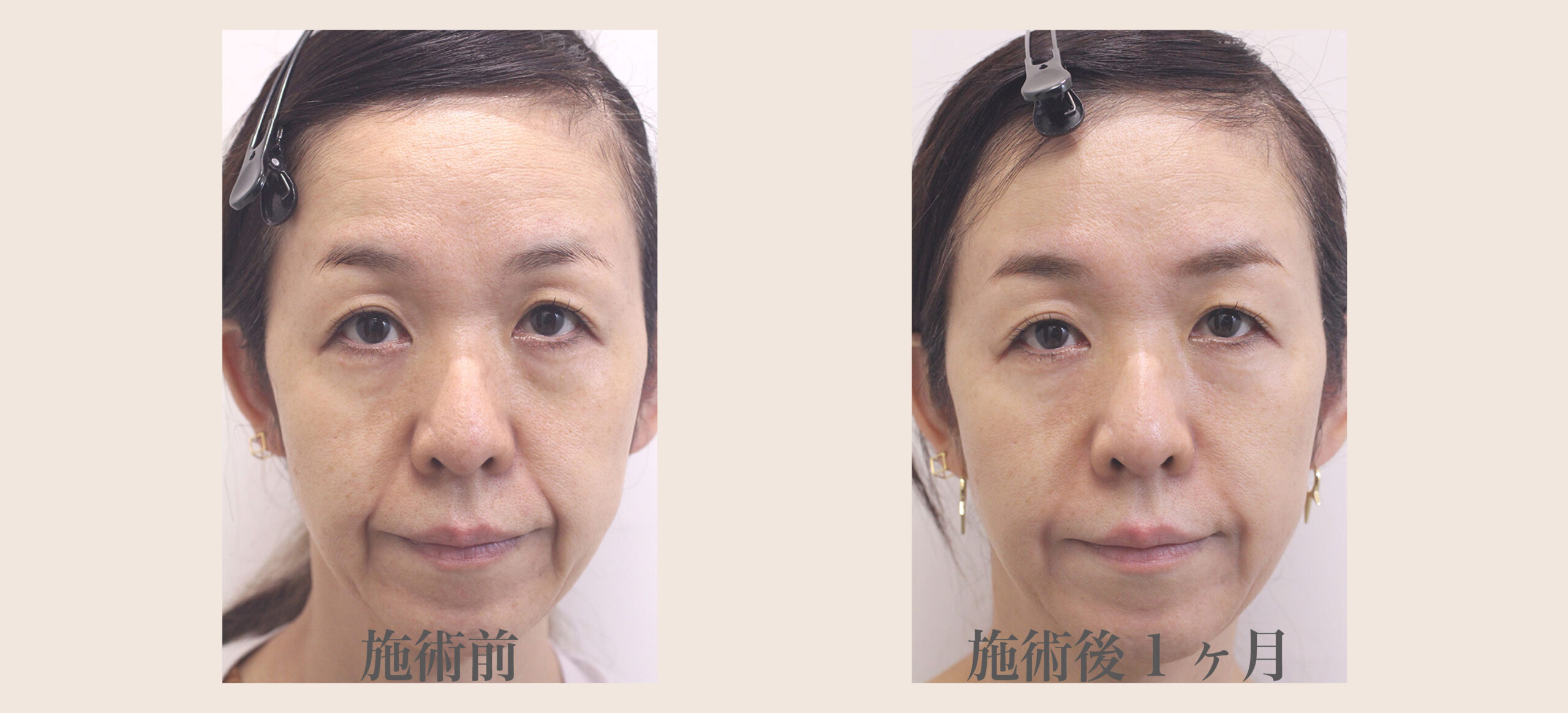 肌の再生医療の症例画像1