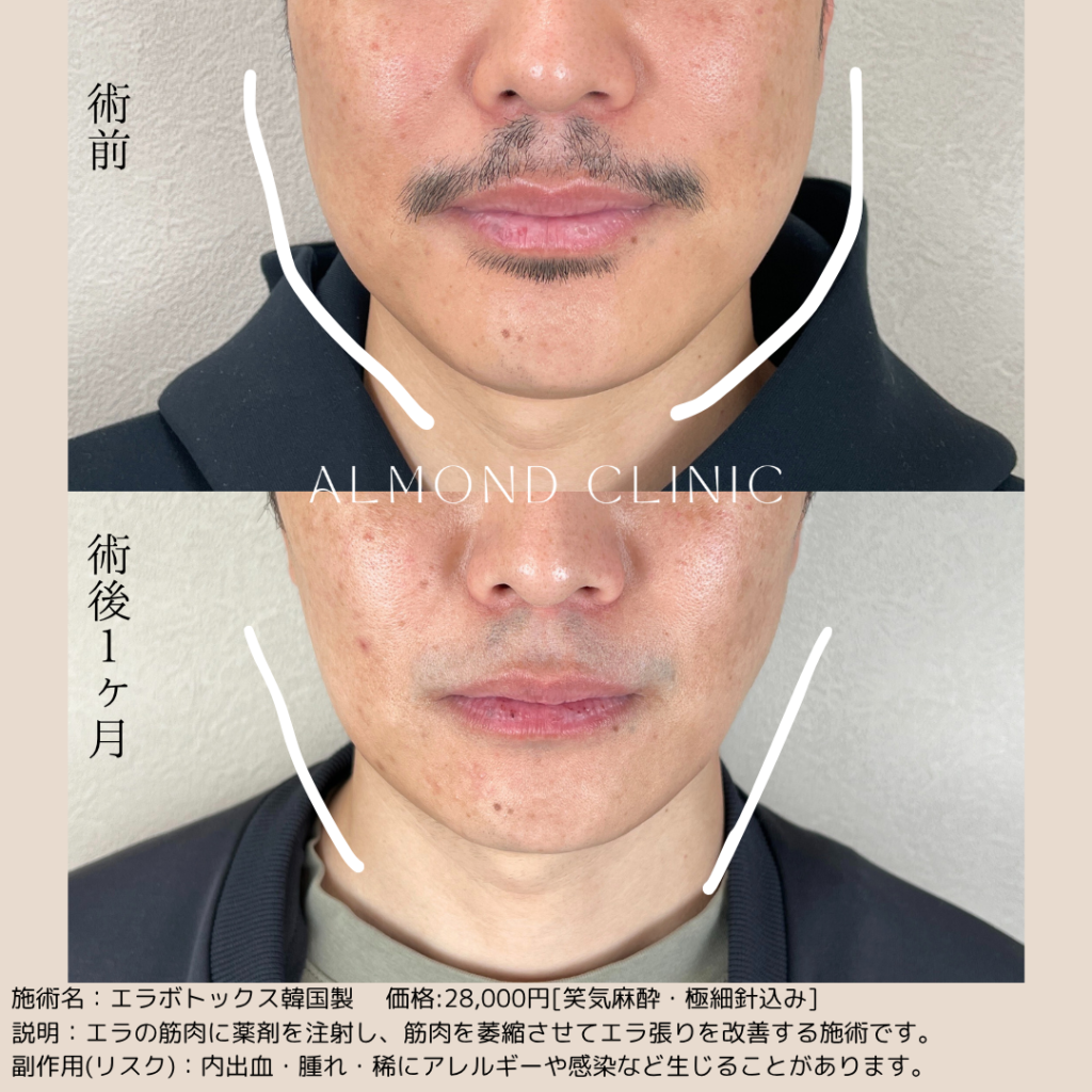 アルモナクリニックのボトックス注射の症例写真（術前・術後）