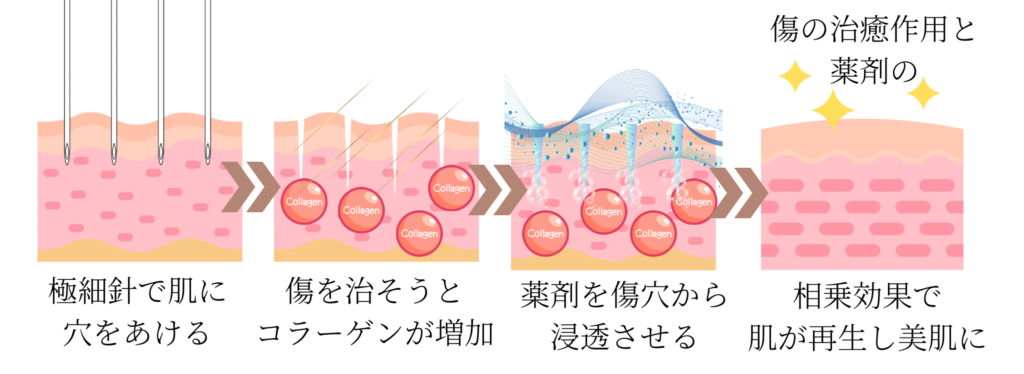 ダーマペンの効果説明