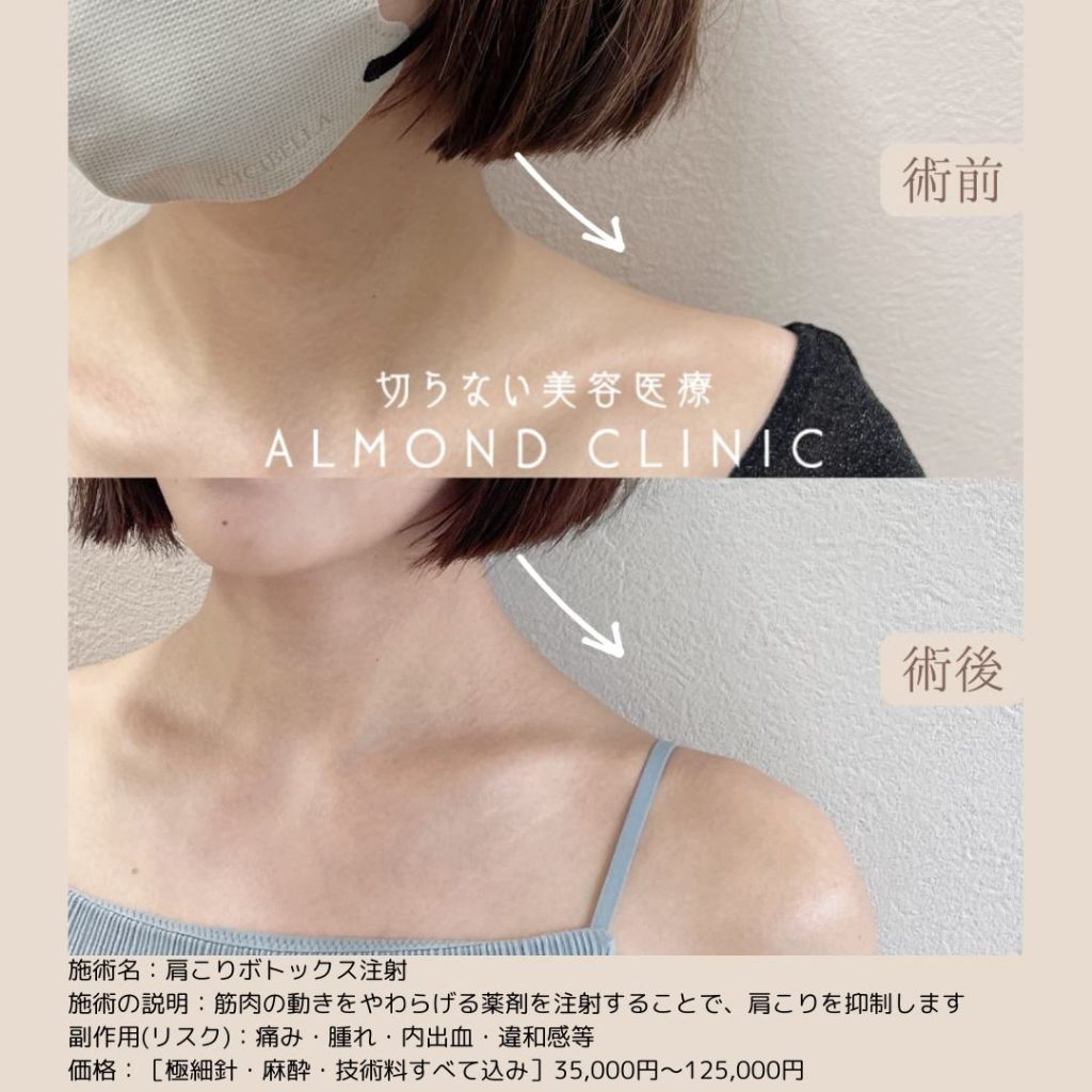 アルモナクリニックのボトックス注射の症例写真（術前・術後）