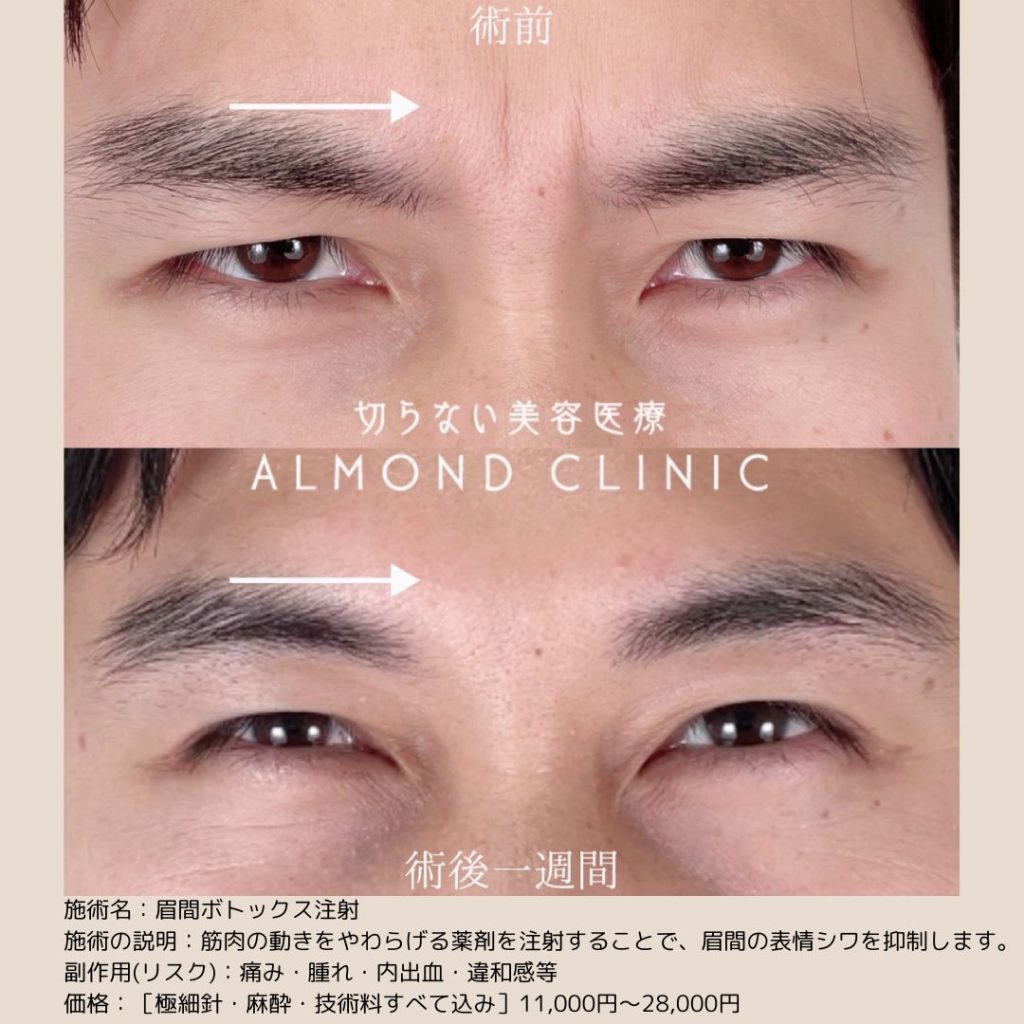 アルモナクリニックのボトックス注射の症例写真（術前・術後）