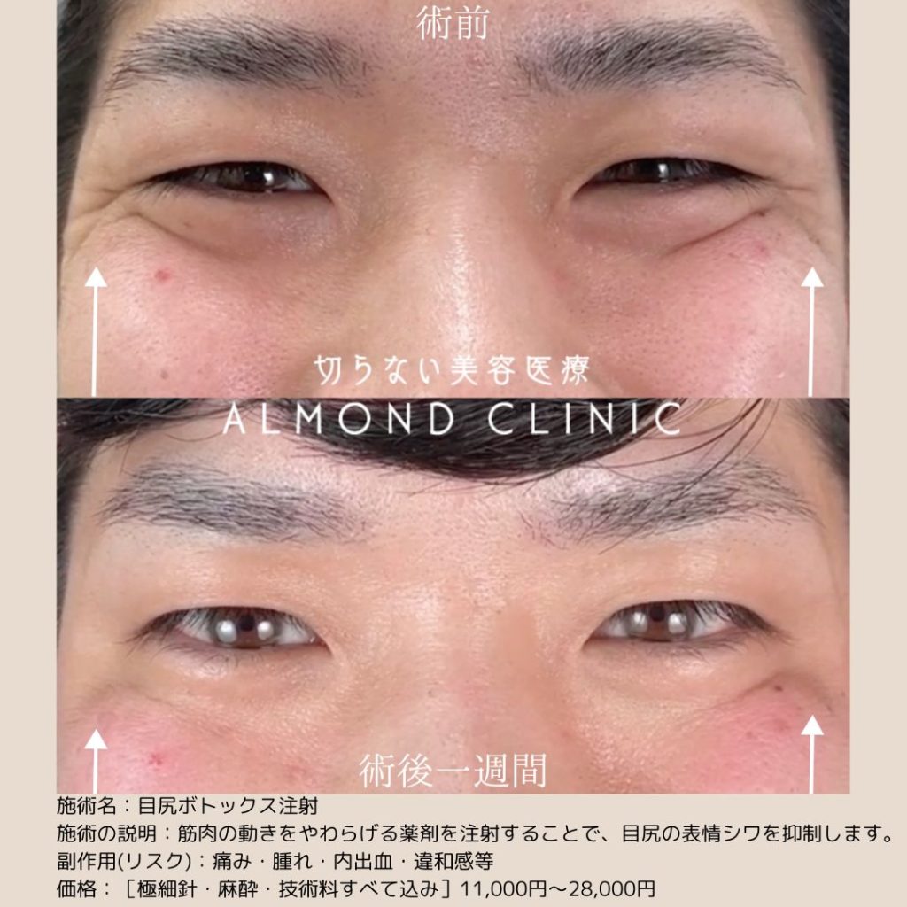 アルモナクリニックのボトックス注射の症例写真（術前・術後）