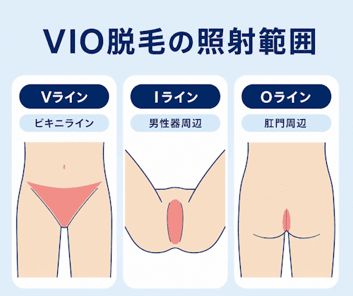 レジーナクリニックオムのVIO脱毛プランの照射範囲