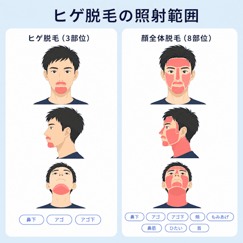 レジーナクリニックオムのヒゲ脱毛プランの照射範囲