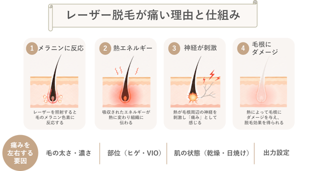 レーザー脱毛痛い理由と仕組み