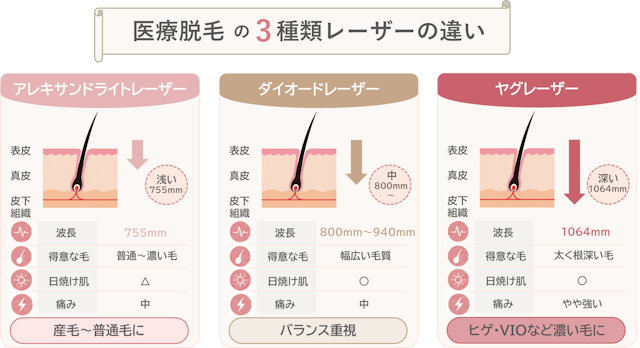 医療脱毛で使用される3種類レーザーの違い