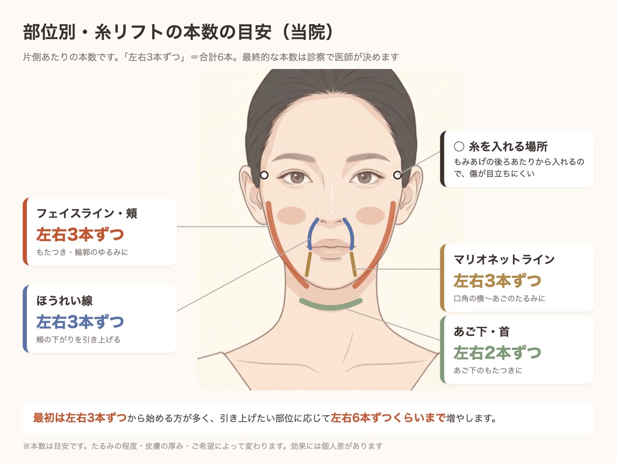 部位別の糸リフトの本数の目安(フェイスライン・頰、ほうれい線、マリオネットラインは左右3本ずつ、あご下・首は左右2本ずつ)