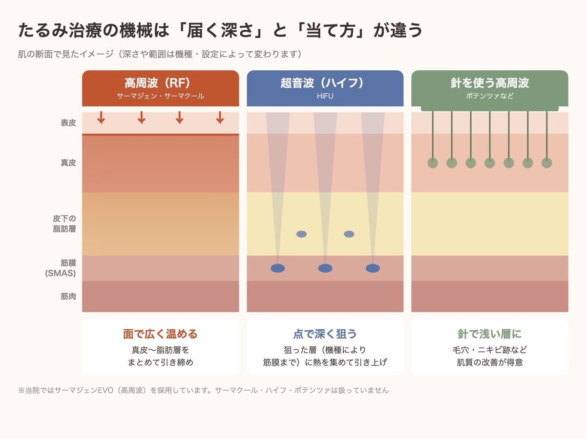 たるみ治療の機械の届く深さと当て方の違い（高周波・ハイフ・針を使う高周波）