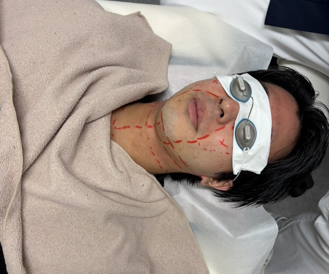 ヒゲ脱毛照射範囲マーカーで示した画像