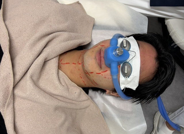 笑気麻酔の装置を装着している画像
