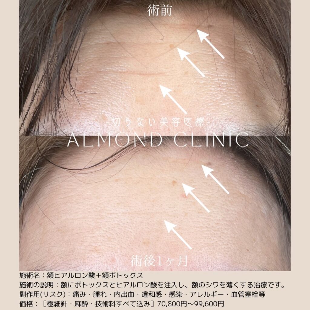 額ヒアルロン酸と額ボトックスの症例写真。額のシワの術前と術後1ヶ月の比較