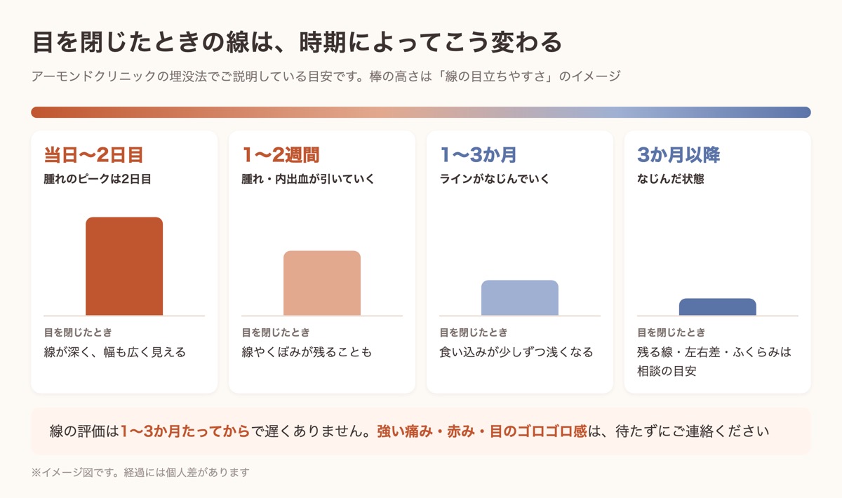 埋没法のあと、目を閉じたときの線が時期によってどう変わるか（当日〜2日目・1〜2週間・1〜3か月・3か月以降）の図