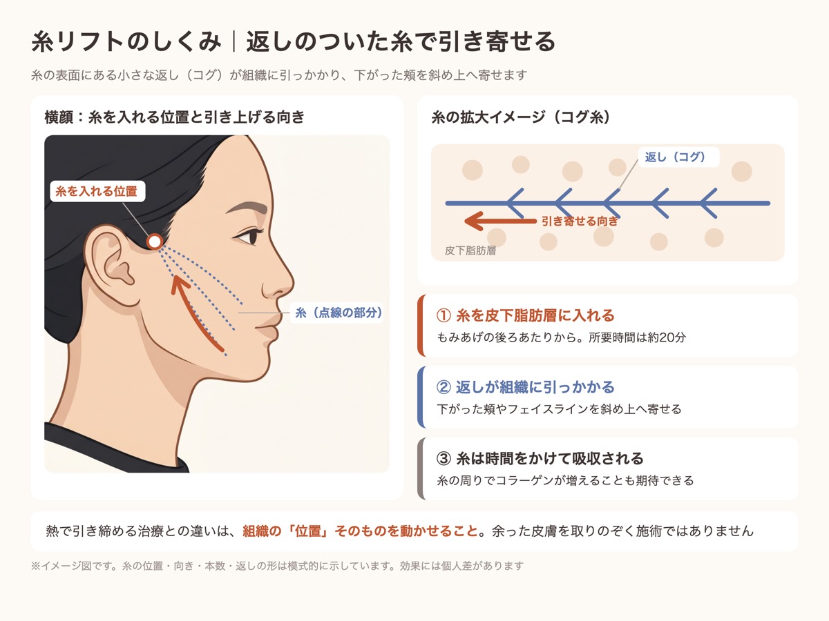 糸リフトのしくみ。もみあげの後ろあたりから入れた返し(コグ)つきの糸が、皮下脂肪層の組織を斜め上へ引き寄せるイメージ図