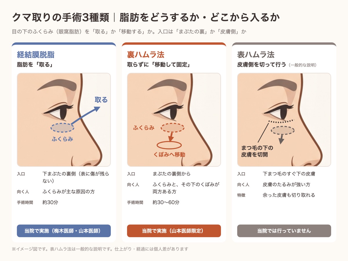 クマ取りの手術3種類の違い。経結膜脱脂は脂肪を取る、裏ハムラは脂肪をくぼみへ移動して固定、表ハムラは皮膚側を切開して行う（当院では行っていない）