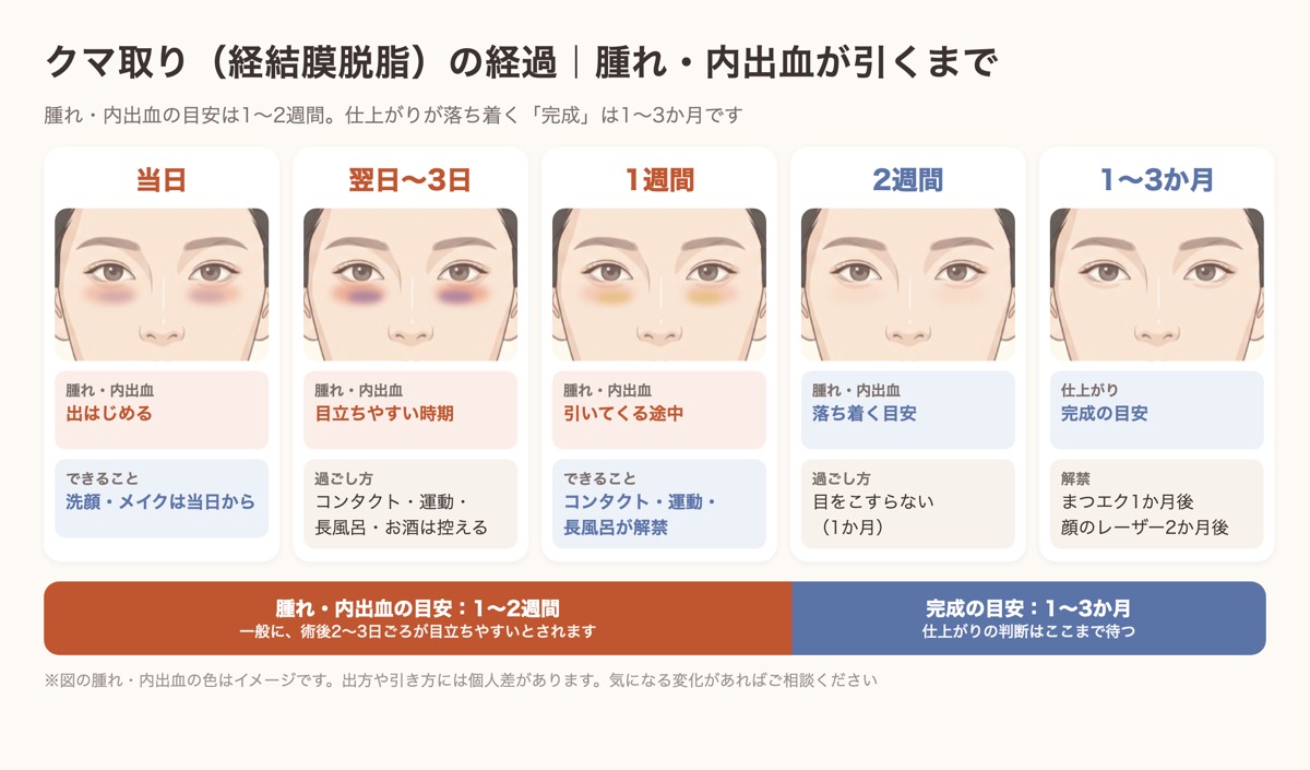 クマ取り（経結膜脱脂）の経過。当日・翌日〜3日・1週間・2週間・1〜3か月で目の下の腫れと内出血が引いていく様子の図