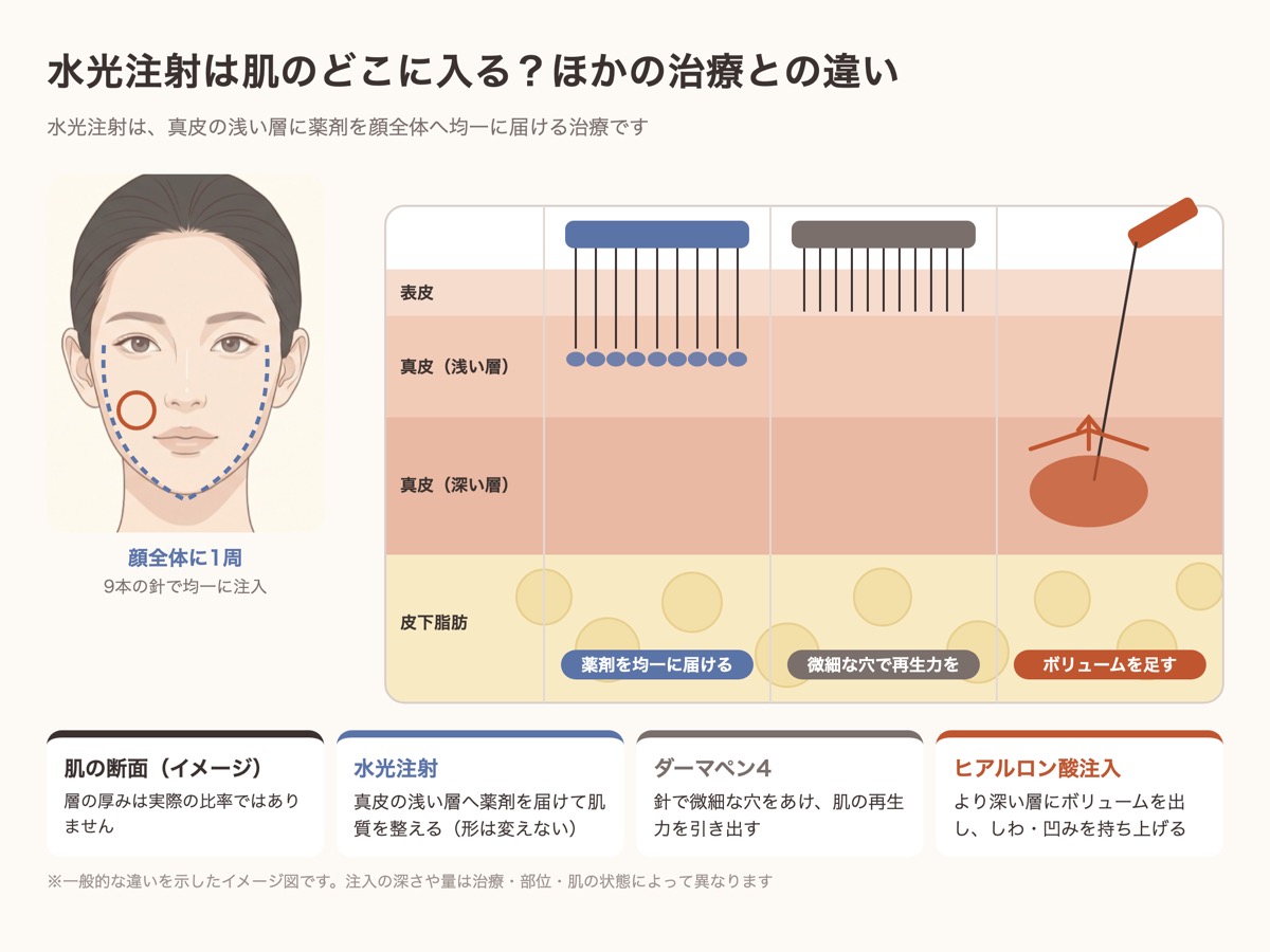水光注射は真皮の浅い層に薬剤を均一に届ける。ダーマペン4やヒアルロン酸注入との違いを示した肌の断面図