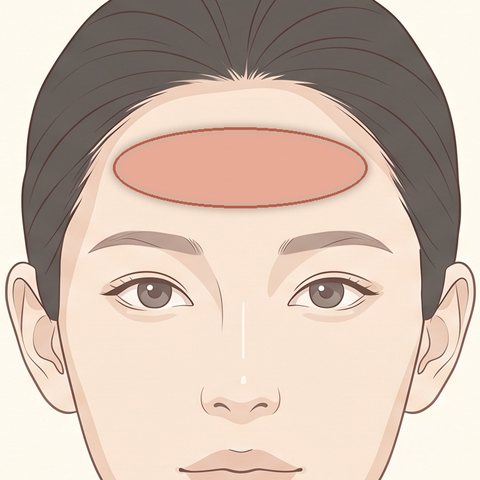 額のボトックス注射の部位イラスト