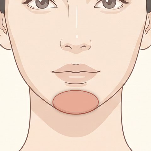 アゴのボトックス注射の部位イラスト