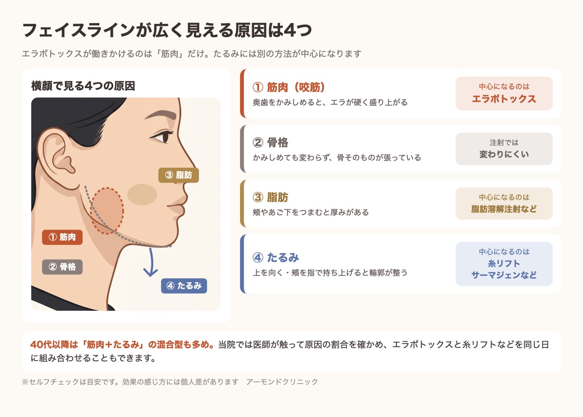 フェイスラインが広く見える4つの原因とエラボトックスが効く範囲を示した図