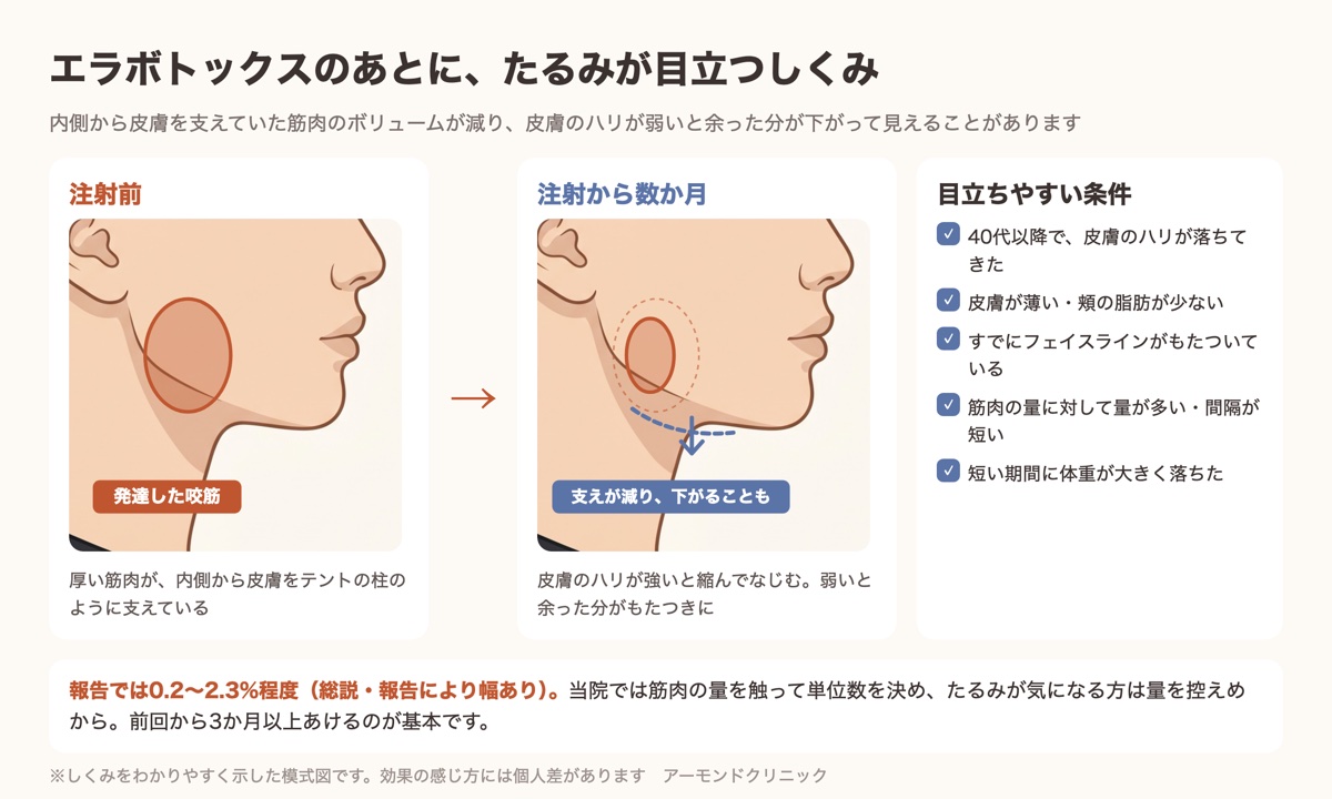 エラボトックスのあとにたるみが目立つしくみと出やすい条件の図