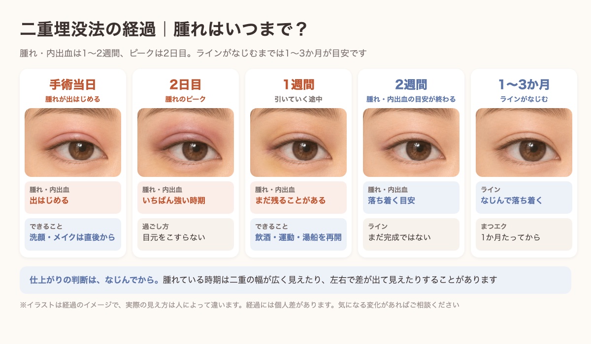 二重埋没法の経過の図。手術当日から腫れが出はじめ、2日目がピーク、1〜2週間で落ち着き、1〜3か月でラインがなじむ