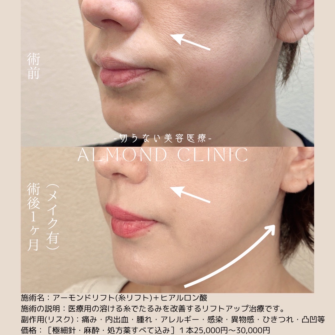 糸リフト（アルモナリフト）とヒアルロン酸の症例写真。術前と術後1か月（メイク有）の、ほうれい線とフェイスラインの比較