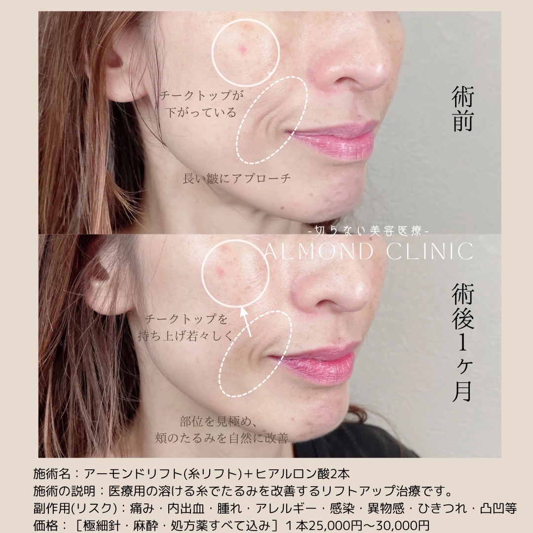 糸リフト（アルモナリフト）とヒアルロン酸2本の症例写真。術前と術後1か月の、頬のたるみとほうれい線の比較