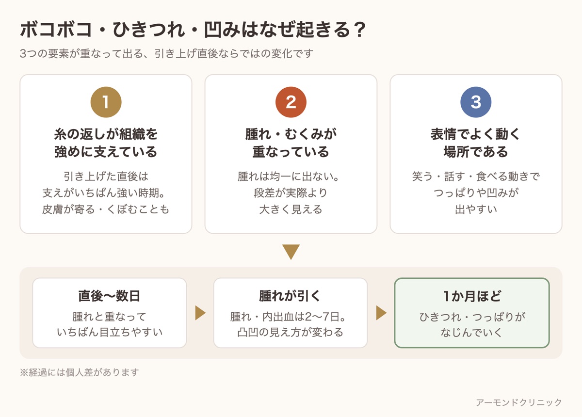 糸リフト後のボコボコやひきつれが起きる3つの理由（糸の返しの支え・腫れとの重なり・表情の動き）と、1か月ほどでなじむまでの流れを示した図