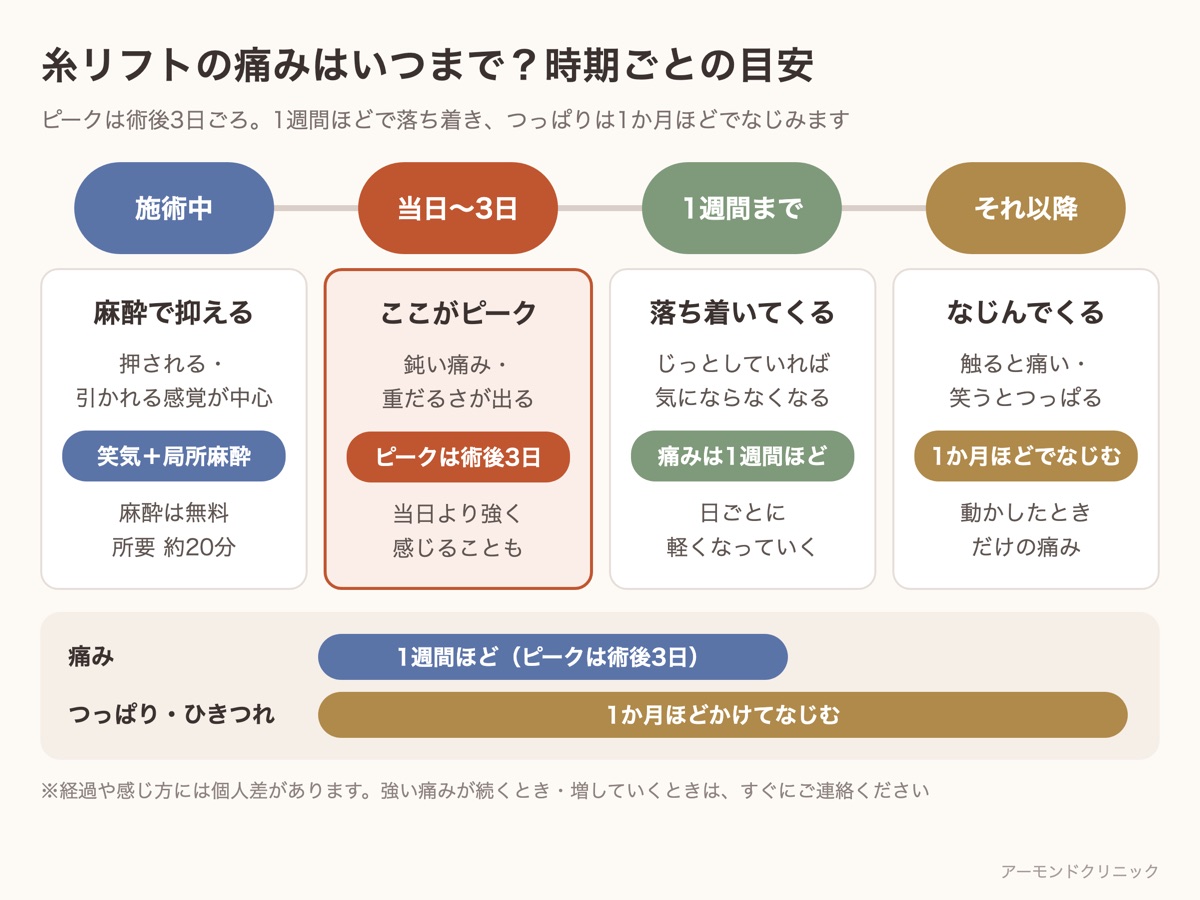 糸リフトの痛みの時期ごとの目安。施術中は麻酔で抑え、ピークは術後3日、痛みは1週間ほど、つっぱりは1か月ほどでなじむことを示した図