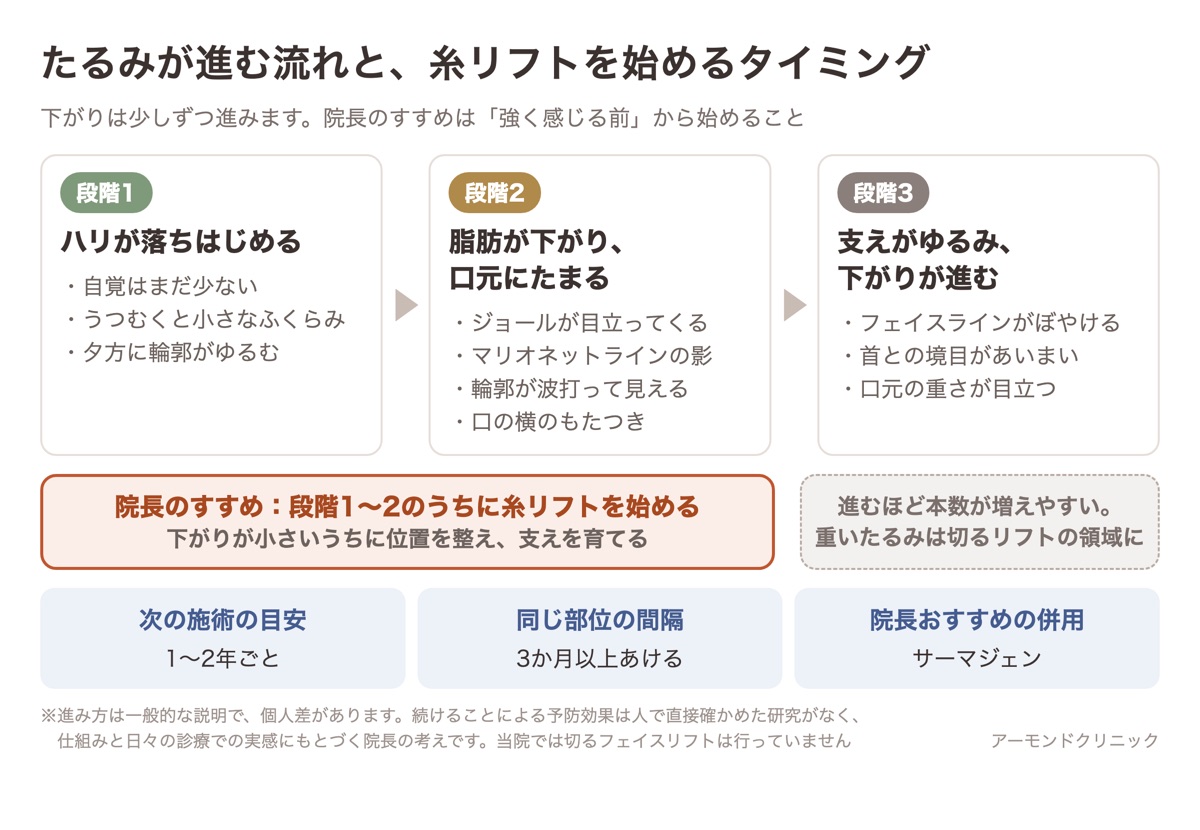 ハリが落ちる、脂肪が下がって口元にたまる、支えがゆるむ、というたるみが進む3段階と、段階1〜2のうちに糸リフトを始めて1〜2年ごとに続けるという院長のすすめを示した流れ図