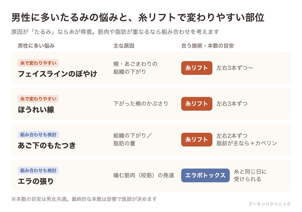 男性に多いたるみの悩み(フェイスライン・ほうれい線・あご下・エラの張り)と、それぞれの主な原因、糸リフトで変わりやすい部位と本数の目安をまとめた表