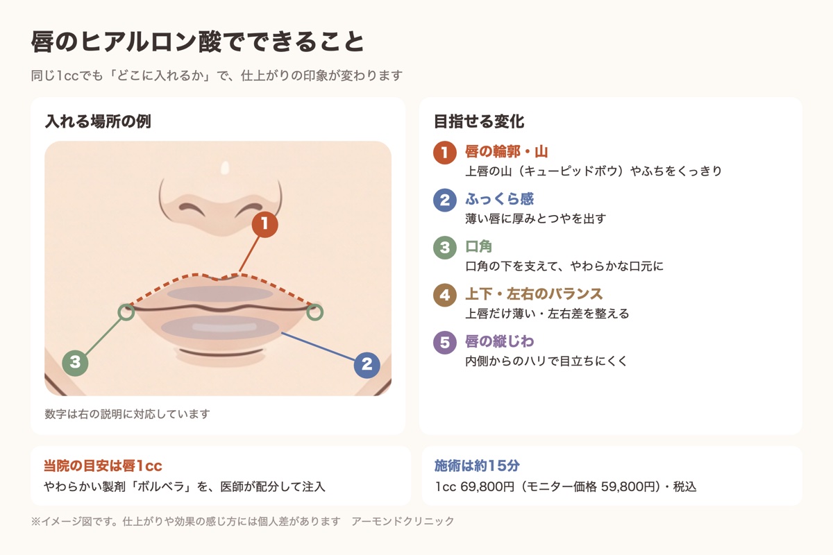 唇のヒアルロン酸で整えられる部位（輪郭・ふっくら感・口角）を示した図