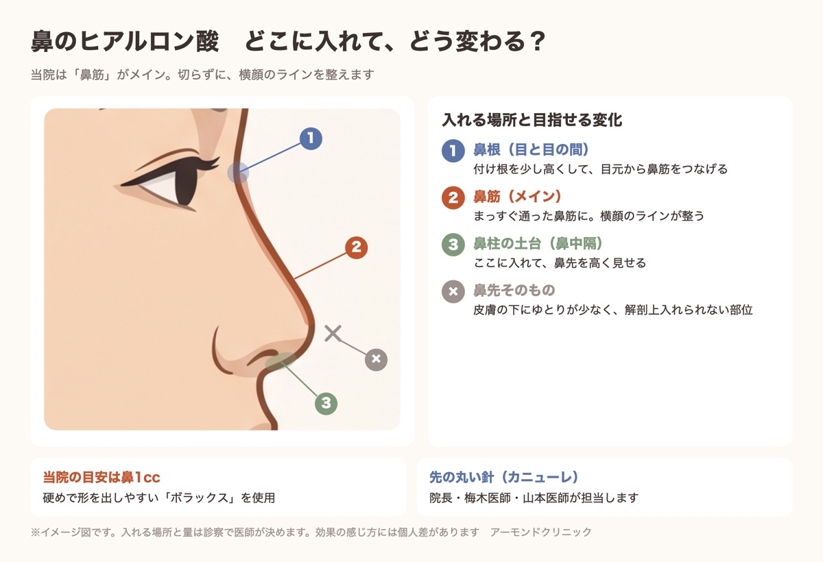 鼻のヒアルロン酸を入れる場所（鼻根・鼻筋・鼻柱の土台）を横顔で示した図